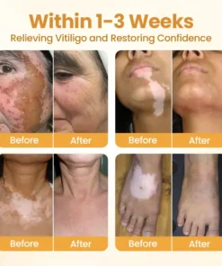 BBOJI™ VitiClear Pro Bee Toxin Cream