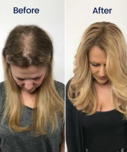 BBOJI® Maximum Strength 5% Minoxidil Fast-Action Hair Growth Serum