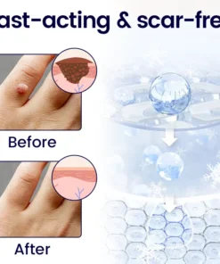 BBOJI® WartErase Cryo Freeze Spray