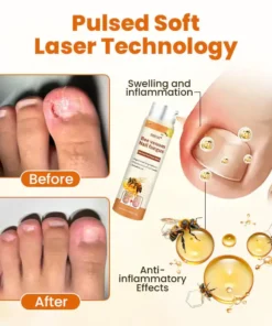 BBOJI® Bee venom Nail fungus Repair Spray