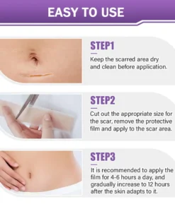 BBOJI® Hyaluronic Acid Nano Microneedle Repair Tape(Treatment of old and new scars, reduction of surgical scars, stretch marks, keloids, acne, burns, warts, dermatomes and varicose veins)